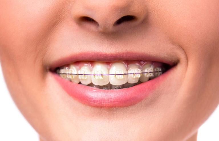 Feste Zahnspange mit dezenten, zahnfarbenen Keramikbrackets