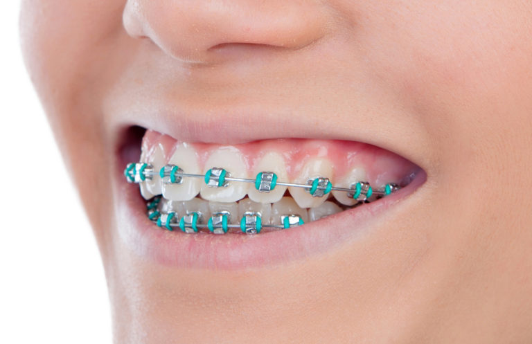 Feste Zahnspange mit sichtbaren Metallbrackets