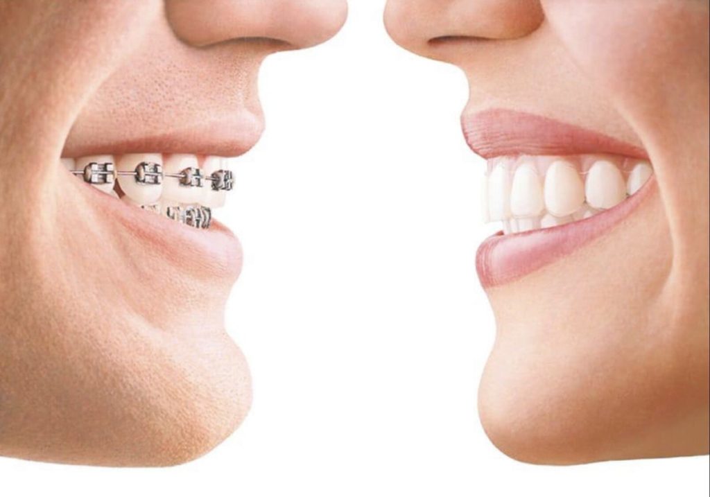 Zahnspangen für die Zähne